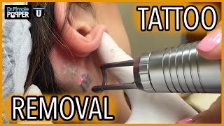 Laser Tattoo Removal  Before amp After  With Erin Jensen [upl. by Kcirddehs170]