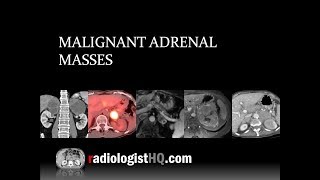 Malignant Adrenal Masses [upl. by Lora]