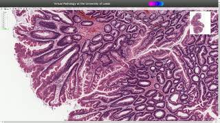 Traditional Serrated Adenoma  Histopathology [upl. by Shannon]