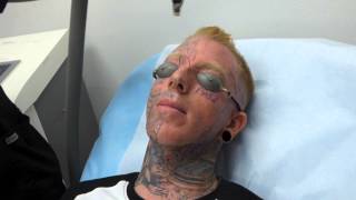 Incredible Face Tattoo Removal  3rd Treatment at Dr Tattoff [upl. by Ahsikcin]