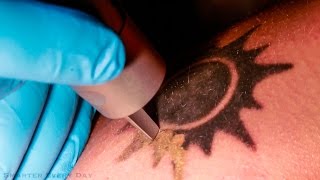 How Laser Tattoo Removal Works  Smarter Every Day 123 [upl. by Oleic]