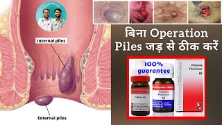 homeopathic medicine for piles piles without pain burning bleeding  piles cure without operation [upl. by Rickard]