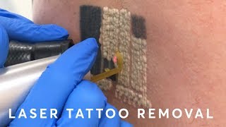 Laser Tattoo Removal PAIN RESULTS amp PROCEDURE [upl. by Ateinotna]