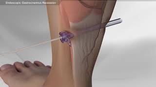 Endoscopic Gastrocnemius Recession [upl. by Abrams375]