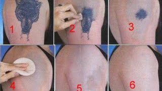 How to Remove a Tattoo without Laser at Home [upl. by Lough]