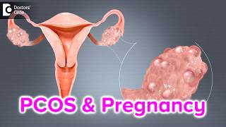 What happens if I have PCOS and I get pregnant  Dr Bala R [upl. by Wilterdink]