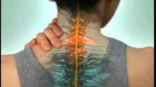 Cervical Radiculopathy  DePuy Videos [upl. by Lyell386]