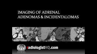 Imaging of Adrenal Adenomas amp Incidentalomas [upl. by Assillam187]