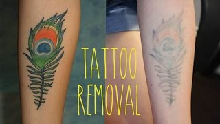 How to Remove a Tattoo  The Most Effective Treatment [upl. by Nnylatsirk]