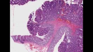 Histopathology Colon Tubular adenoma adenomatous polyp [upl. by Yentihw]