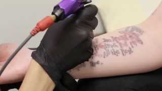 Nonlaser Tattoo Removal [upl. by Ferd]