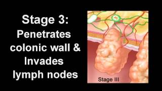 What to Expect • Colonoscopy [upl. by Nimad]