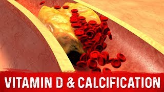 Vitamin D and Coronary Artery Calcification Explained by DrBerg [upl. by Dew295]