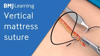 Vertical Mattress Suture  BMJ Learning [upl. by Roxine297]