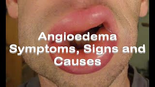 Angioedema  Symptoms Signs and Causes [upl. by Austin478]