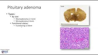 Brain Pituitary adenoma [upl. by Prowel]