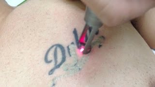 Tattoo Removal using Spectra Laser  Los Angeles Skin Perfect Brothers [upl. by Forrester]