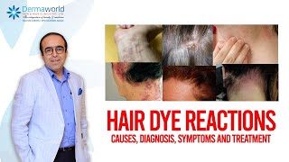 Hair dye reactions  Causes Diagnosis Symptoms and Treatment [upl. by Horick]