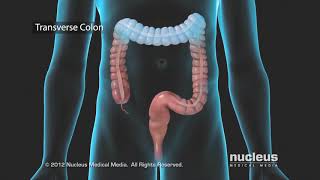 Colon Problems Diverticular Disease [upl. by Nored]