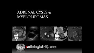 Adrenal Cysts and Myelolipomas [upl. by Hewe]