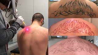 Laser Tattoo Removal  The Ugly Truth [upl. by Ahsino]