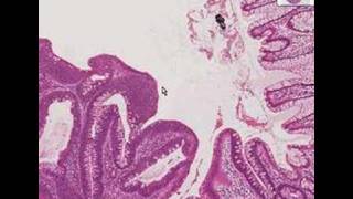 Histopathology ColonTubular adenoma [upl. by Ilysa]