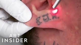 How Tattoo Removal Works [upl. by Othilie]