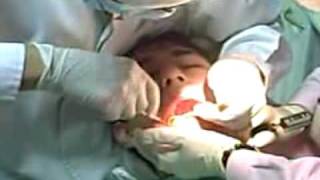 Dentistry Horrors Wisdom tooth procedure full [upl. by Casia]