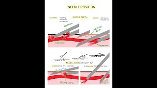 Venipuncture  How to Position a Needle [upl. by Norda]