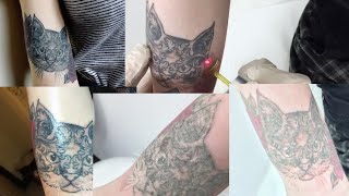 Laser Tattoo Removal Journey  BEFORE amp AFTERS [upl. by Vincent]